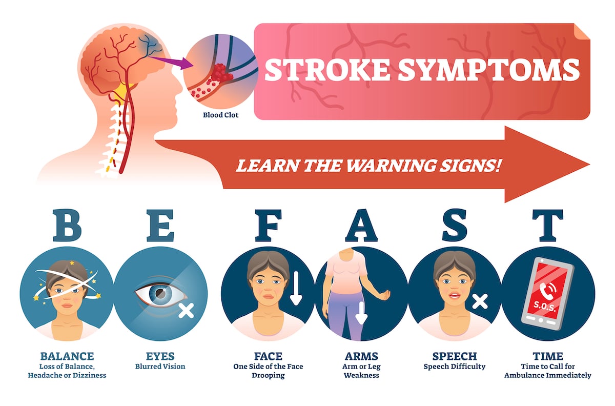 Stroke signs and symptoms