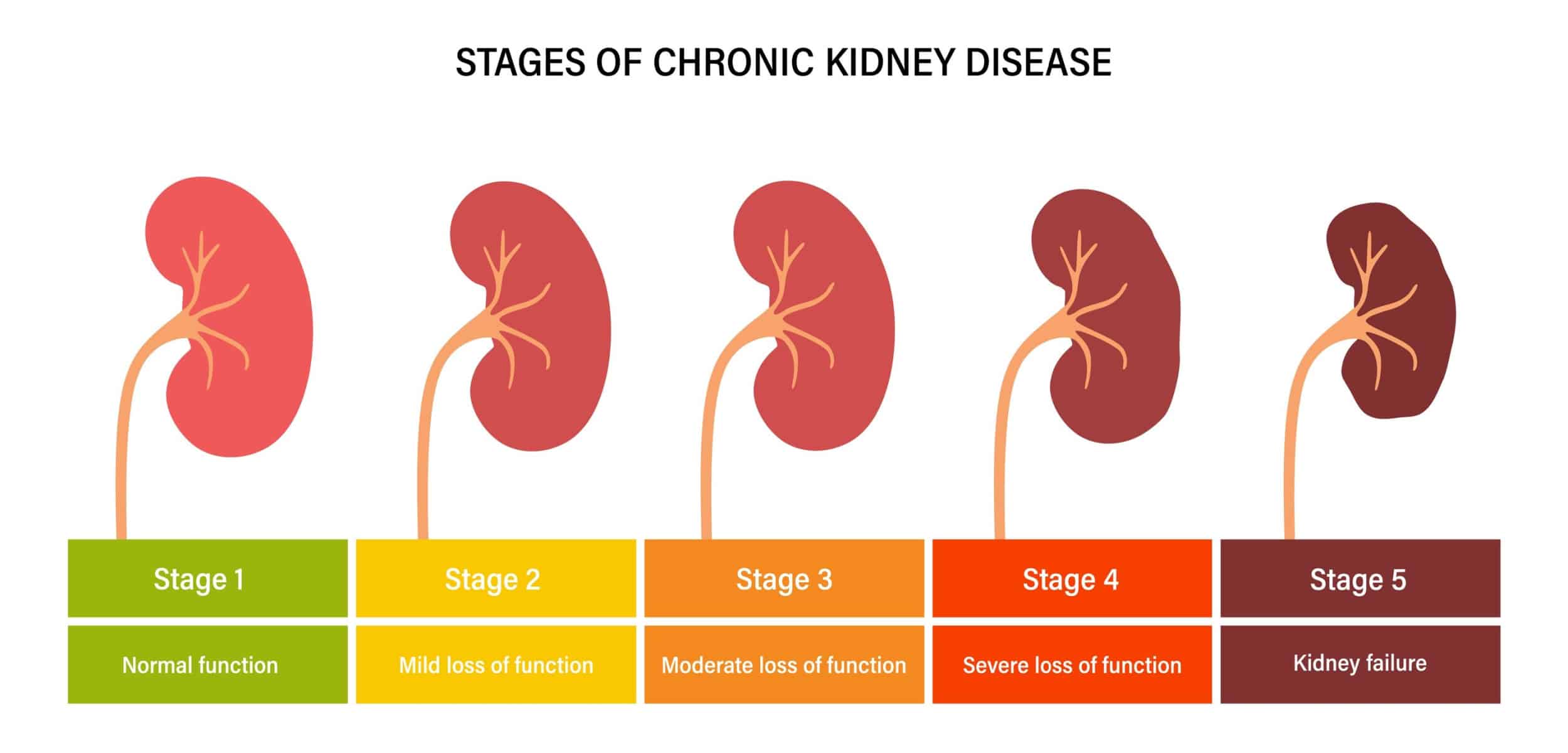 Stages of chronic kidney disease